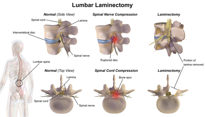 Is this normal? Spinal laminectomy